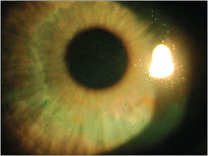 Note lissamine central staining five days post-photo-refractive keratectomy in this DED patient.