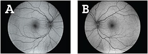 Central photos of normal Plaquenil patient with Eidon AF