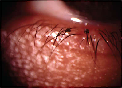 Collarettes, or cylindrical dandruff, as seen here, are a sign of demodex, a mite linked with blepharitis.&#xA;PHOTO CREDIT: Art Epstein, O.D. F.A.A.O.