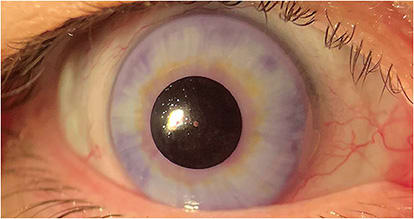 Figure 3. Final result with a well-concealed right eye. Image courtesy of Dr. Gregory W. DeNaeyer.
