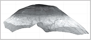 Figure 6: Severe oblate cornea