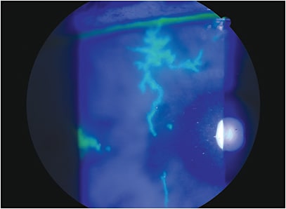 HSV epithelial keratitis showing classic terminal end bulbs.
Courtesy of Josh Johnston, O.D., F.A.A,O.