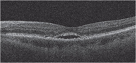 AMD OS recurrent subretinal pathology warranting referral back to a retina specialist. (Not the patient described.)
Photos Courtesy of Jay M. Haynie, O.D., F.A.A.O.