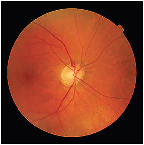 Superior disc hemorrhage is a sign of disease progression.
Image courtesy of Dr. Lifferth.