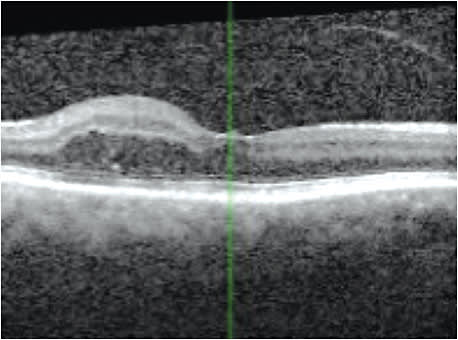Improvement in edema after injections of anti-VEGF and Ozurdex. Her VA improved to 20/50.
Courtesy of Dr. Rashid M. Taher
