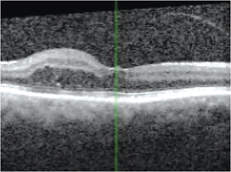 Improvement in edema after injections of anti-VEGF and Ozurdex. Her VA improved to 20/50.
Courtesy of Dr. Rashid M. Taher