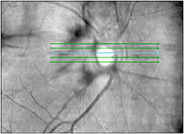 Shown above is a partial PVD with persistent traction of the posterior hyaloid membrane on the optic nerve. It’s vitreopapillary traction syndrome.