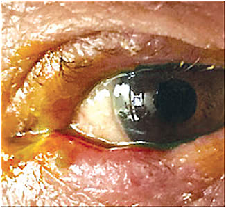 Note the inflamed and edematous lid with mucopurulent discharge. This patient had chronic blepharitis and meibomian gland dysfunction with acute bacterial conjunctivitis.&#xA;&#xA;Courtesy of Josh Johnston, O.D., F.A.A,O.&#xA;