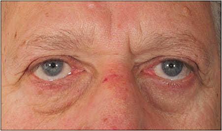Lower lid laxity. Presence of inferior sclera showing an upward slope of lower eyelid confirms diagnosis. 
Courtesy of Vance Thompson Vision