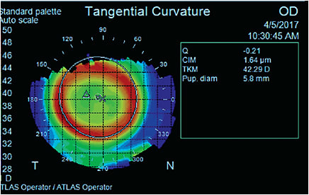 Successful treatment zone of a patient wearing ortho-k lenses for myopia control. Patient is 6 years old and starting prescription was -2.00D. Vision was 20/20 after one day of lens wear.