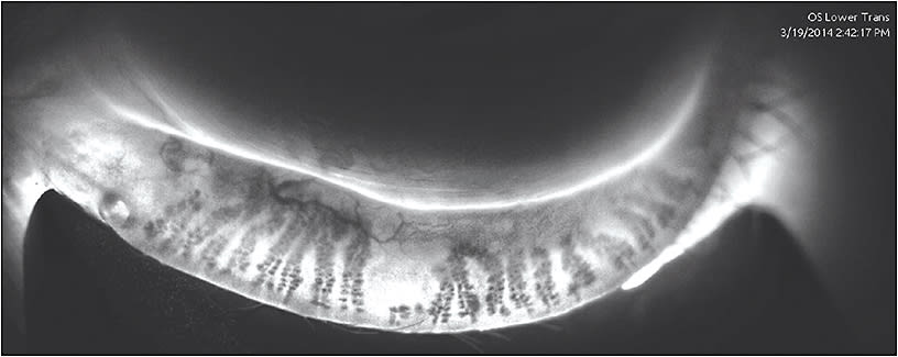 FIGURE 1. Meibomian gland morphology with truncation and dropout. This image was captured with dynamic meibomian imaging in the trans-illumination mode, which reduces potential for false reads that can occur with a gland bent anteriorly when viewed only with reflective IR.