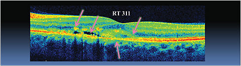 Figure 2: SDOCT OS shows intraretinal fluid, pigment migration into the intraretinal space, disruption of the retinal pigment epithelium (RPE) and a hyper-reflective lesion above the RPE.