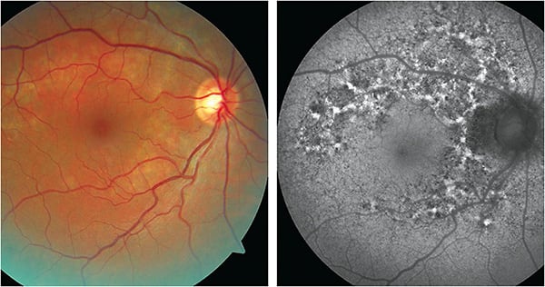 Figure 3. Clinical (left) and FAF image (right) of 47-year-old patient complaining of blur at intermediate distances.Images courtesy Dr. Nick Fogt.