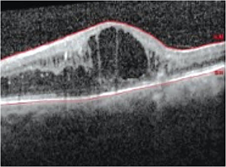 SD-OCT of an 84-year-old white female with a history of hypertensive retinopathy and retinal vein occlusion with macular edema. Her VA was 20/400. 
Courtesy of Dr. Rashid M. Taher