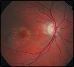 Saucerization of the subfoveal area.&#xA;Courtesy of Diana L. Shechtmsn, O.D., F.A.A.O.
