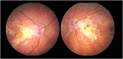 79-year-old female with advanced GA OU and severe vision loss OD 20/400, OS 20/400.