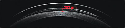 Figure 1: AS-OCT of a fit scleral lens with a central corneal clerance value of 293 μm