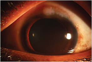 This vernal conjunctivitis patient had itching, tearing and burning.