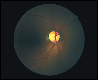 Optic nerve pallor present OD&#xA;Courtesy of Dr. Diana Shechtman