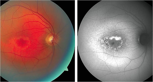 Figure 1. Clinical (left) and FAF image (right) of a 52-year-old patient, previously diagnosed with Stargardt and complaining of mild blurred vision.Images courtesy Dr. Nick Fogt.