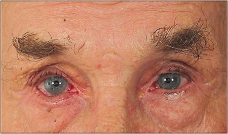 Trichiasis/entropion. Eyelash trimming can provide relief, but more permanent solutions are available.
Courtesy of Vance Thompson Vision