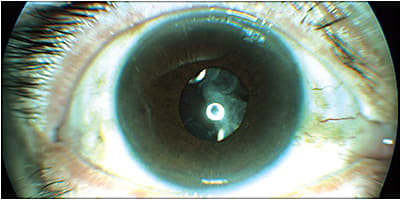 Overseeing post-op care: Cortex material limited the vision and caused chronic uveitis after cataract surgery. The residual cortex was removed with additional irrigation and aspiration.