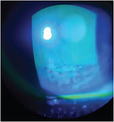 Corneal staining detected pre-fitting. Pattern suggests incomplete blink.Image courtesy of Dr. Susan A. Resnick.