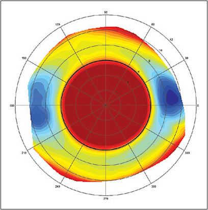 Figure 5: Against-the-rule scleral toricity