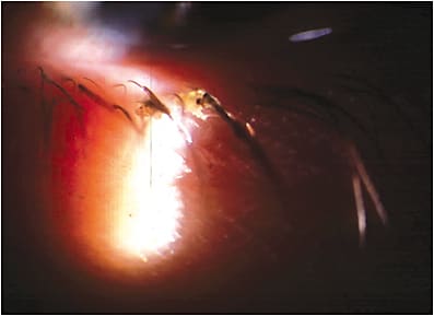 Note the dandruff-like scurf, which accompanies blepharitis, or inflammation of the anterior lid margin. Blepharitis also includes red, swollen eyelids, erythema, lash loss crusting and matting with lid debris.&#xA;PHOTO CREDIT: Art Epstein, O.D. F.A.A.O.