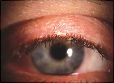 Note the crusting of the lid and lashes, which is indicative of blepharitis.&#xA;PHOTO CREDIT: Art Epstein, O.D. F.A.A.O.