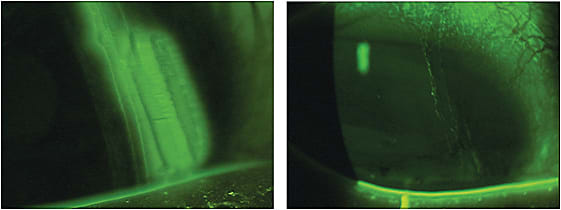 Corneal abrasion before, left, and after 12 hours of bandage contact lens.