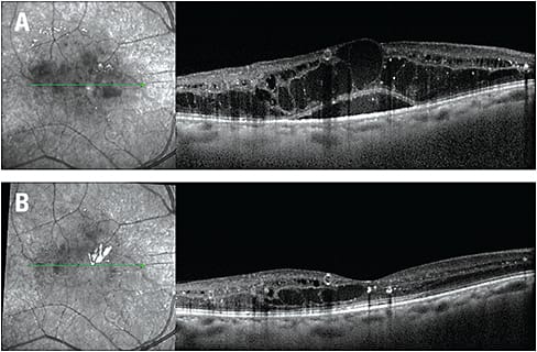 A) This is an OCT of a patient who has diabetic macular edema. VA was 20/100. B) OCT showing improvement in edema after multiple injections of an anti-VEGF drug. Vision improved to 20/60. Images: Courtesy of Mohammad Rafieetary, O.D., F.A.A.O