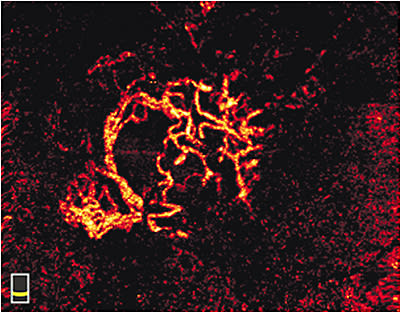 Patient with occult choroidal neovascularization and AMD via OCTA.
Courtesy of Praven Dugel via Optovue.