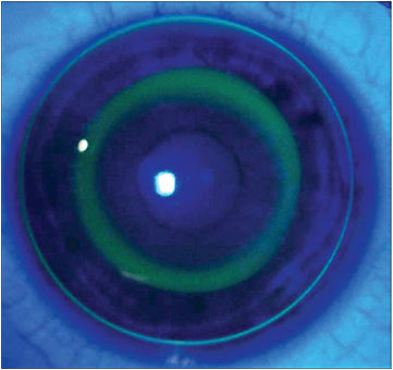 Sodium fluorescein pattern of a reverse geometry ortho-k lens