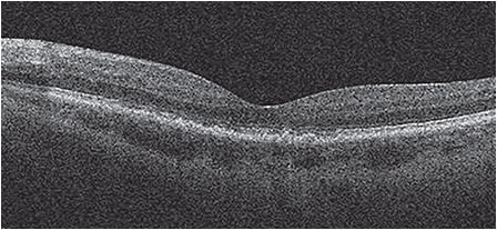 AMD OS stable post anti-VEGF injections. (Not the patient described.)
Photos Courtesy of Jay M. Haynie, O.D., F.A.A.O.