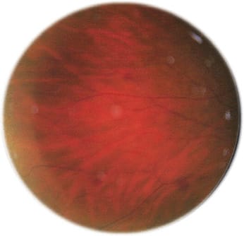 Mid-peripheral hemorrhages in an OIS patient.
Image courtesy of Dr. Sherrol A. Reynolds