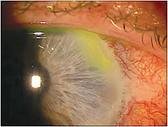 Note the linear infiltrate near the 2 o’clock position on the cornea in this S. marginal keratitis patient.
Courtesy of Josh Johnston, O.D., F.A.A.O.