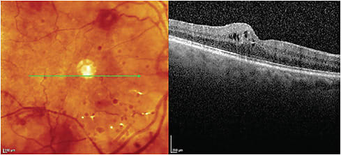 Single cross section of the retina taken with OCT. Notice the intraretinal edema in the superficial retina. Images courtesy of Dr. Jacqueline Theis.