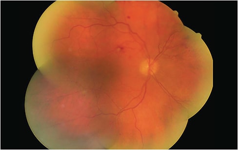 Montage of five separate fundus photos, acquired post-image capture, enables an increased field of view. Image courtesy of Dr. Jacqueline Theis.