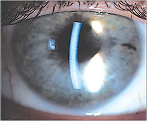 Note the central guttae in this patient’s FCD.
Courtesy of Bob Prouty, O.D.