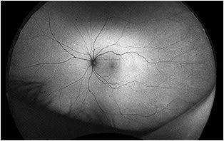 Asymptomatic 59-year-old female with 20/20 VA. FAF of left eye shows a healthy macula; Courtesy of Professional Eye Care Center