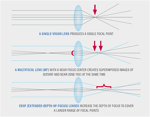 Figure 1. A single-vision lens produces a single focal point (top). A multifocal lens (MF) with a near-focus center creates superimposed images of distant-and near-zone foci at the same time (middle). EDOF (extended-depth-of-focus) lenses increase the depth of focus to cover a larger range of focal points (bottom). All three models shown are deliberately simplified by using a monochromatic light source and paraxial rays to reduce distracting aberrations.