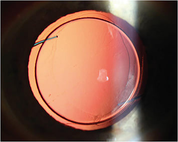 Figure 1. A three-piece monofocal IOL.PHOTO COURTESY OF AARON BRONNER, OD.