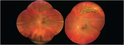 Figure 3. Perivascular lattice before and after prophylactic barrier retinopexy.