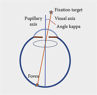 Figure 1. Velasco-Barona C, Corredor-Ortega C, Mendez-Leon A, et al. Influence of Angle κ and Higher-Order Aberrations on Visual Quality Employing Two Diffractive Trifocal IOLs. Journal of Ophthalmology. 2019;2019:7018937. Licensed under a Creative Commons Attribution 4.0 International License, http://creativecommons.org/licenses/by/4.0/ . No changes were made.