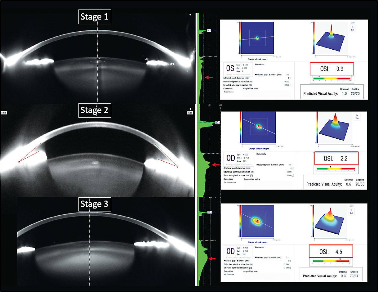 Figure 2. The three stages of dysfunctional lens syndrome. From: Waring GO, Rocha KM. Characterization of the Dysfunctional Lens Syndrome and a Review of the Literature. Curr Ophthalmol Rep. 6, 249–255, 2018