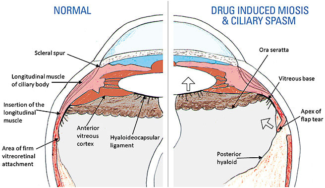 Figure 1. Proposed mechanism of retinal break formation with drug-induced miosis and ciliary spasm.