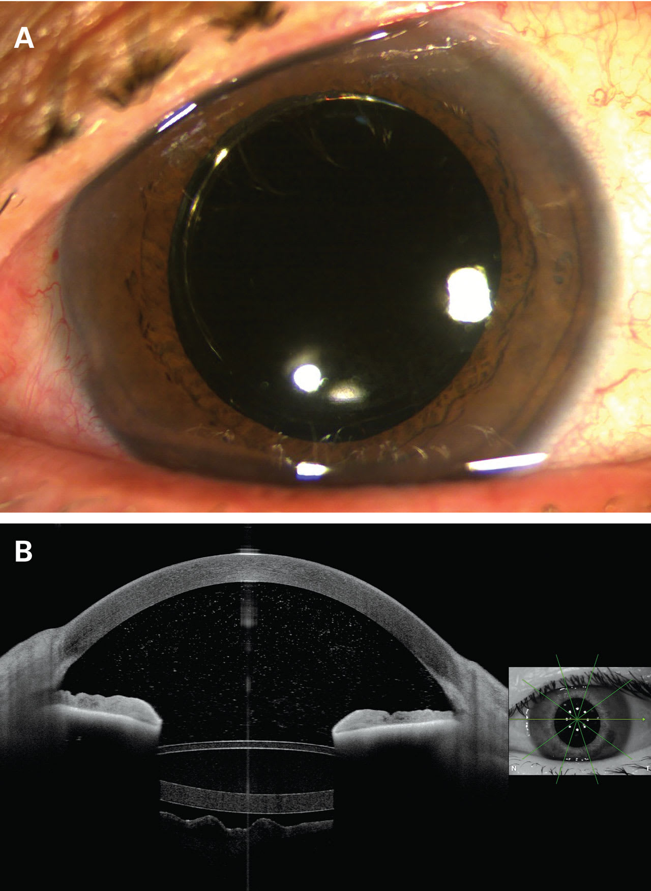 Figure 3. Slit-lamp photograph and anterior-segment optical coherence tomography of JelliSee implanted in a human eye.
