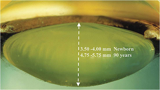 Figure 3. The shape of the lens in Phase 0 changes throughout life, becoming thicker with age.IMAGE COURTESY OF JOHN MARSHALL, PHD.