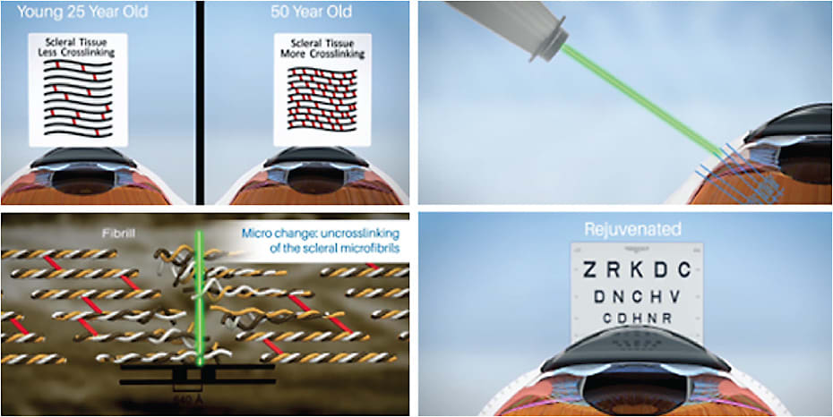 Figure 3. LSM therapy for presbyopia. (Upper left) Collagen crosslinking increases with age, causing increased stiffness. (Upper right) LSM creates micropores in the sclera overlying the accommodative apparatus. (Lower left) LSM disrupts the weave of collagen fibers, reversing the effect of crosslinking. (Lower Right) Accommodative function is restored.